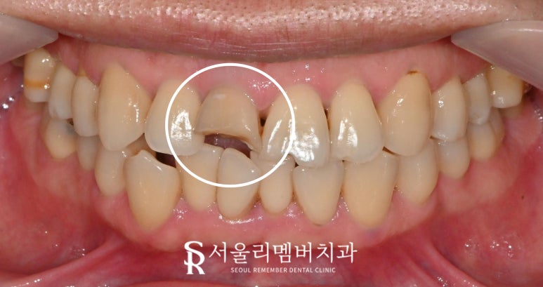 사당 치과 치수 침범 치관 파절로 부러진 앞니 당일 신경치료 후 크라운 관련 이미지 2