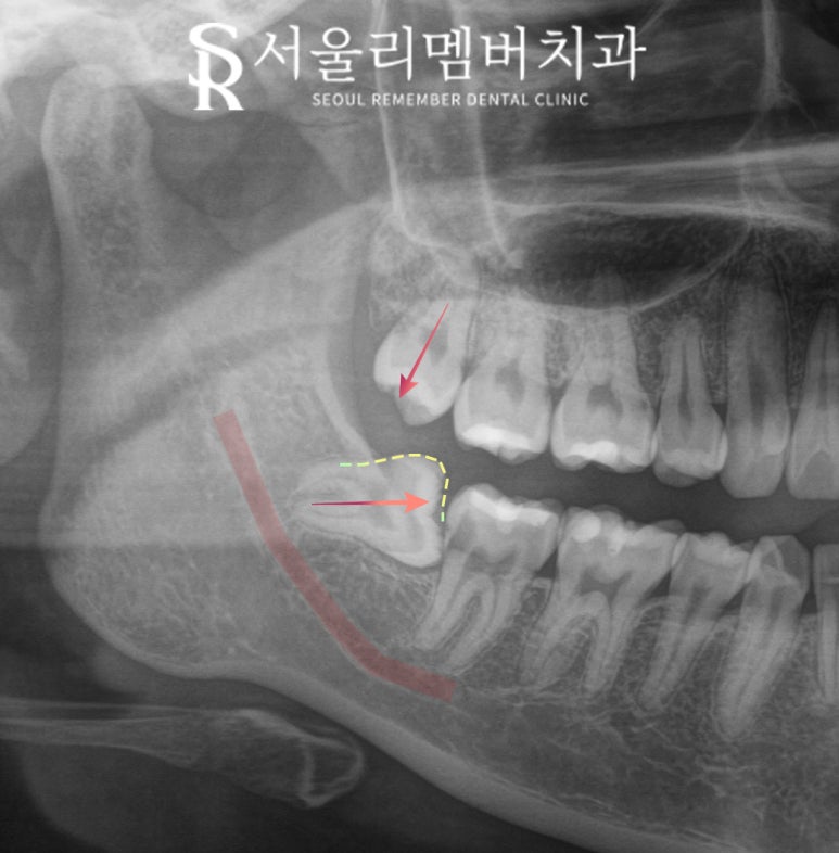 사랑니 주변 잇몸이 자꾸 붓고 아프다면? 서울대입구역 치과 발치 꼭 해야 될까? 관련 이미지 1