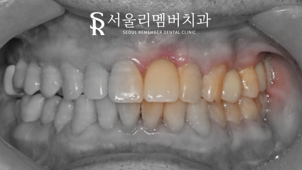 앞니 임플란트 관련 이미지 2