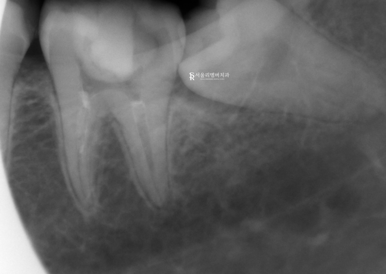 서울대입구역 치과 근관치료 증례 관련 이미지 3