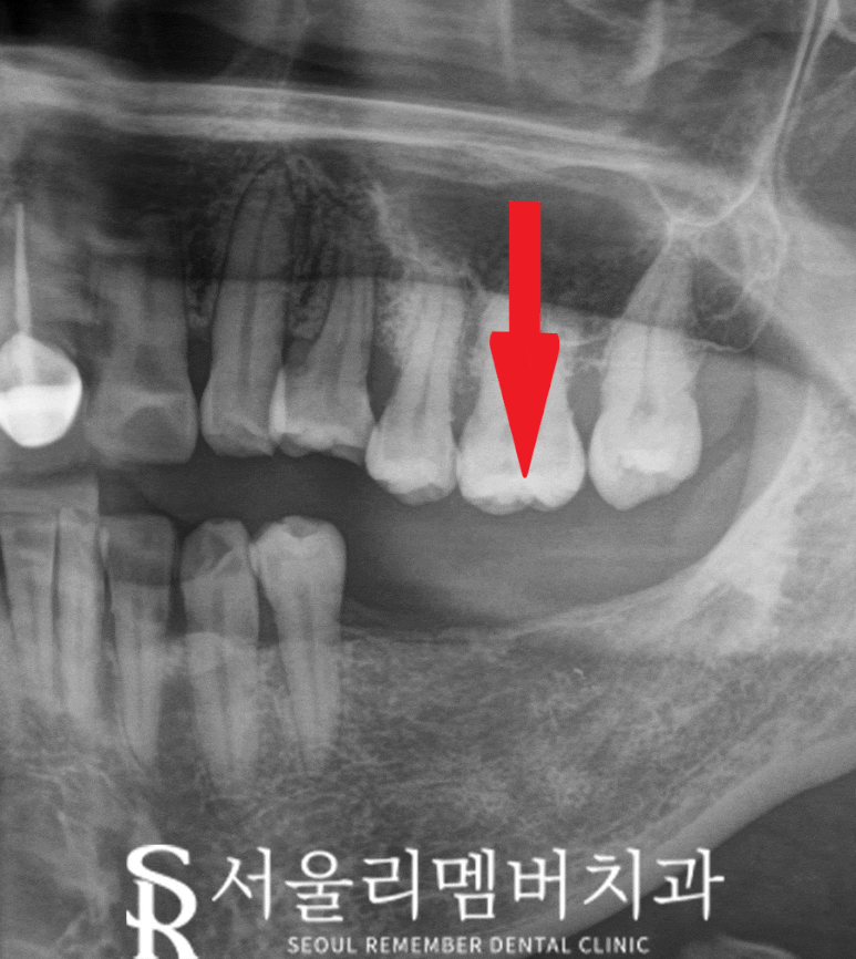 낙성대 치과 "어금니가 없어요." 가이드 임플란트와 신경치료 과정 관련 이미지 3