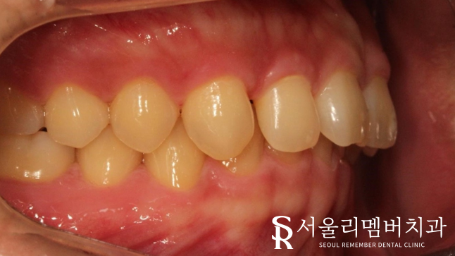 과개교합, 외적인 문제는 물론이며 기능 회복까지 개선하는 것이 중요합니다. 신대방치과 치아교정 관련 이미지 3