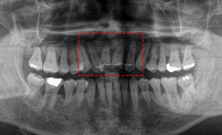 보라매 치과 삐뚤어진 교합 불량 앞니, 임플란트로 가지런하게 만들어드린 사례 관련 이미지 4