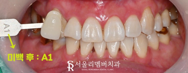 신림 치과 에서 전문가 치아 미백으로 안전하게! 관련 이미지 3
