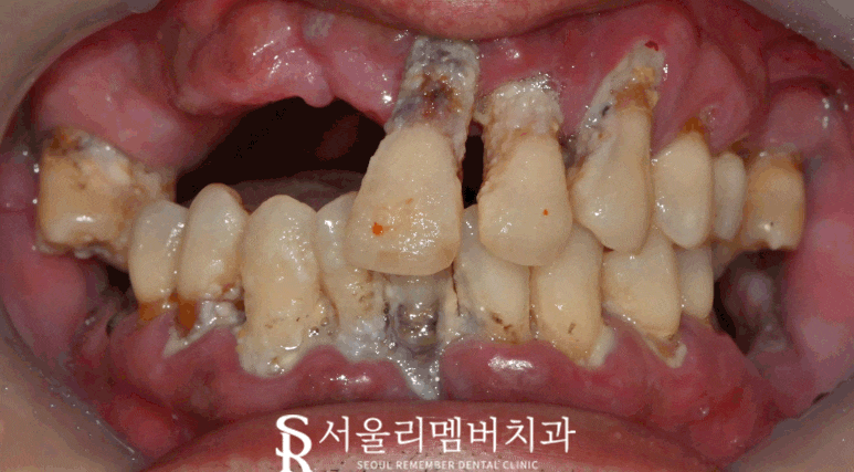 "도저히 음식을 먹지 못해요" 봉천역 치과 수면 임플란트 치료 사례 관련 이미지 7
