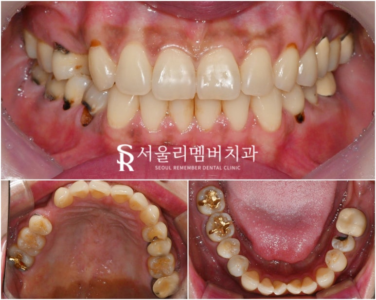 신림 치과 신경치료와 임플란트 어떤 기준으로 결정하게 되는지 궁금하다면 <클릭> 관련 이미지 3