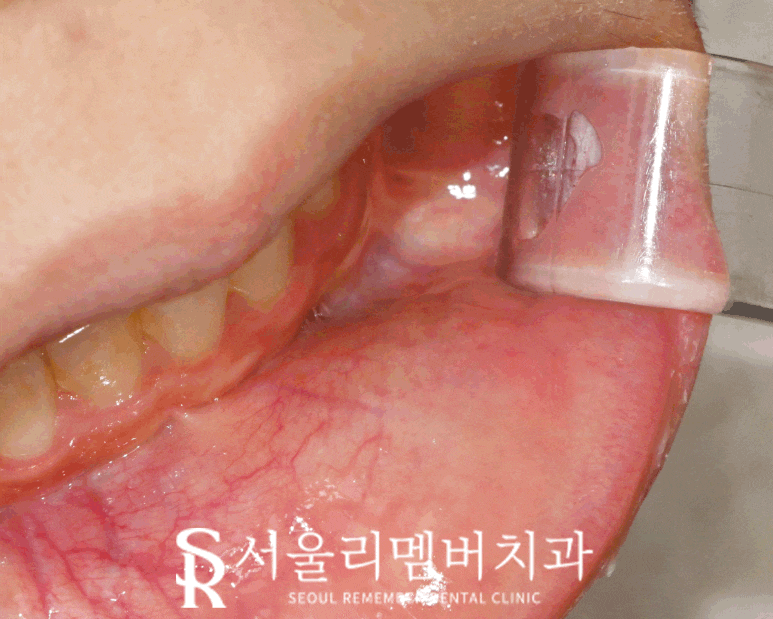 입술에 생긴 볼록한 혹? 관악구 치과 점액낭종(Mucocele) 진단과 제거 치료 방법 관련 이미지 4