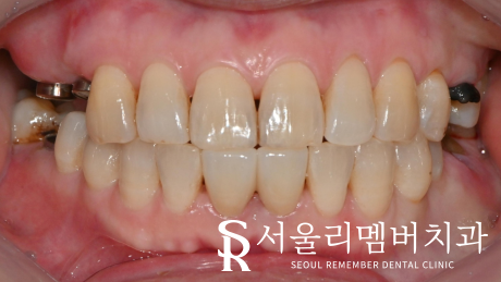 보라매역 치과 신경치료 및 크라운으로 기능과 외관 되살리기. 관련 이미지 2