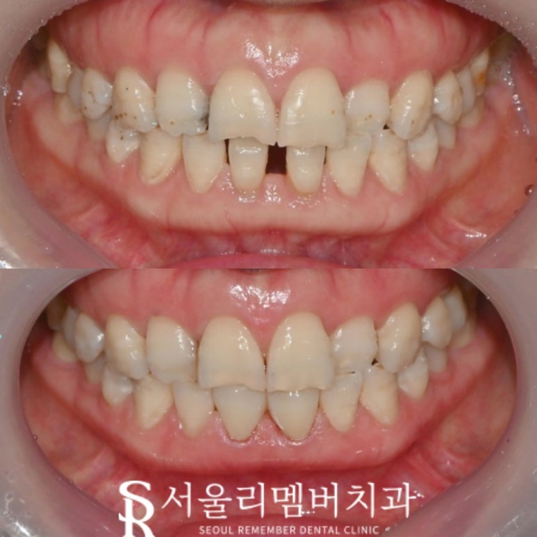 "앞니 벌어짐 어떻게 해결할까?" 신림역 치과 의 치료방법 관련 이미지 3