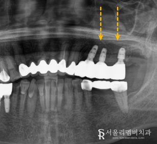 부러진 어금니, 사당역 치과 에서 안전하고 튼튼한 임플란트 식립 방법 관련 이미지 3