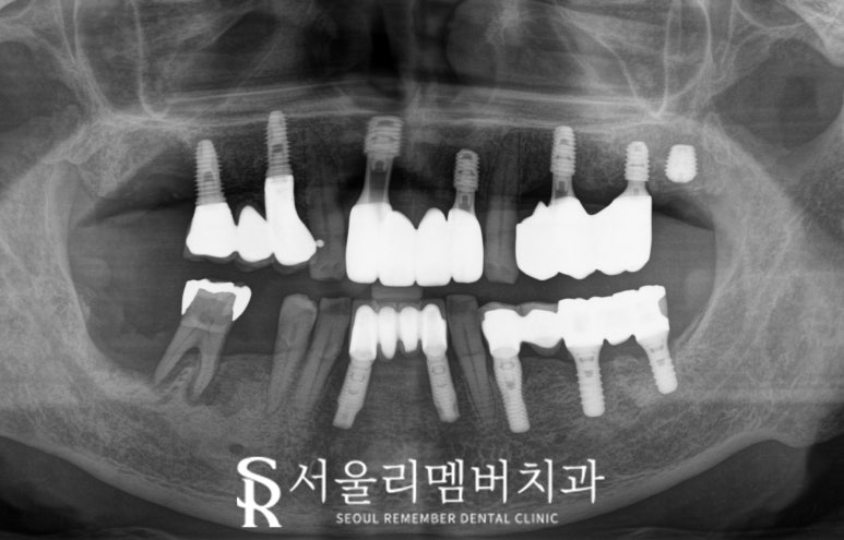 서울대입구역 치과 에서 최소 비용으로 다수 임플란트 브릿지 크라운 진행한 케이스 관련 이미지 3