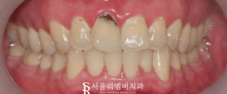 치아 부식으로 인한 마모와 충치, 낙성대 치과에서 해결 관련 이미지 1