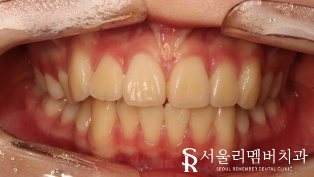 인비절라인을 사용한 치아 총생 개선 증례! 청룡동 치과 관련 이미지 2