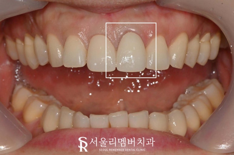 봉천동 치과 위 앞니 크라운 마음에 안 든다면? 상악 중절치 보철 재제작 재치료 과정 관련 이미지 2