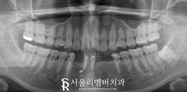 서울대입구역치과 에서 아래 앞니 5개를 임플란트 2개만으로 자연스럽게 회복 관련 이미지 1