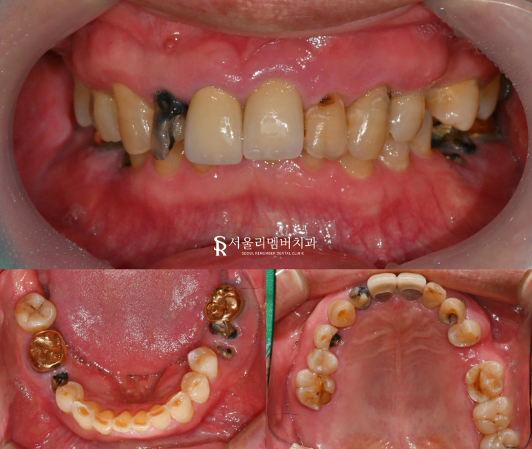 낙성대 치과 다수 상실된 치아 가이드 임플란트 식립으로 정확하고 튼튼한 치료 후기 관련 이미지 1