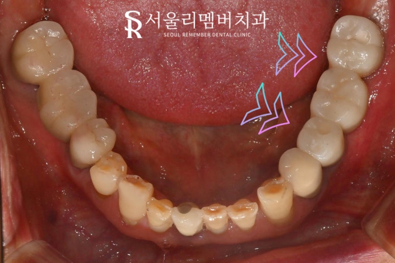 왼쪽 아래 어금니 임플란트 브릿지 장점, 진행 과정, 빨리 치료해야 되는 이유 상도동 치과 관련 이미지 6