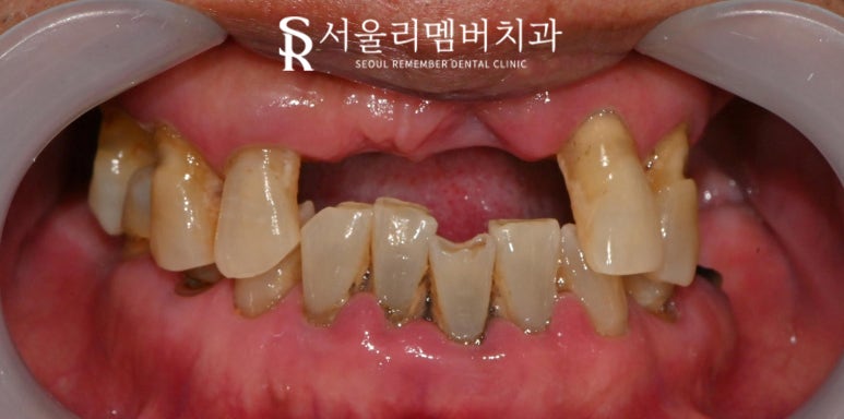 사당 치과 하악 전치 신경치료 브릿지로 살리고 나머지 임플란트로 재건한 전악 증례 관련 이미지 2