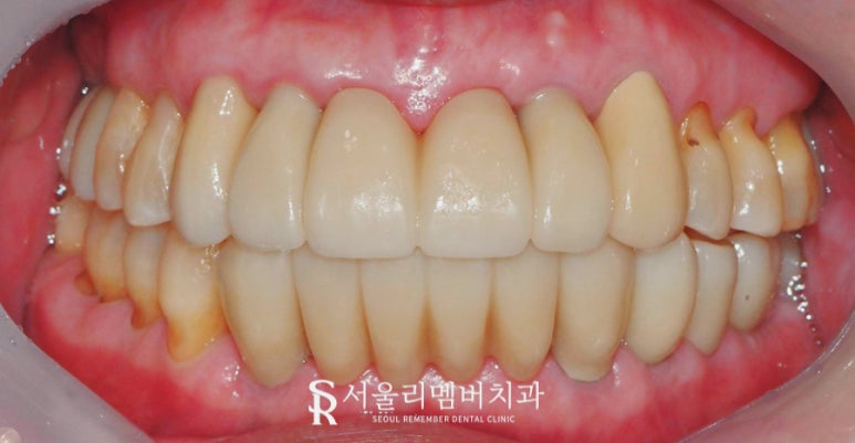 서울대입구역 치과 잇몸이 내려앉아서 고민이라면 전악 임플란트로 해결 관련 이미지 4