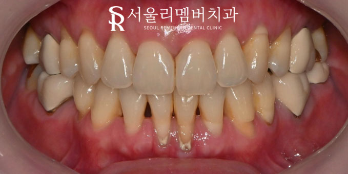 "이가 누렇고 패어있어요." 신림 치과 에서 치경부 마모증 레진 치료와 치아 미백으로 개선한 증례 관련 이미지 1