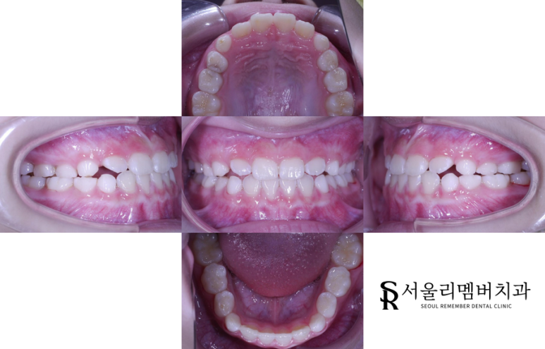 반대교합 후 관련 이미지 1