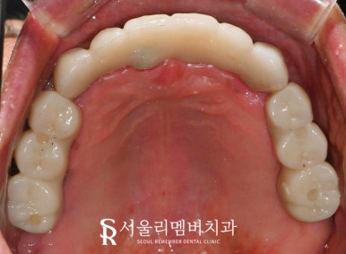 사당 치과 하악 전치 신경치료 브릿지로 살리고 나머지 임플란트로 재건한 전악 증례 관련 이미지 13