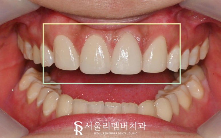 서울대입구 치과 결손된 앞니 자연스러운 라미 리얼네이트로 변색 레진과 사이 공간 막을 수 있다면 관련 이미지 6