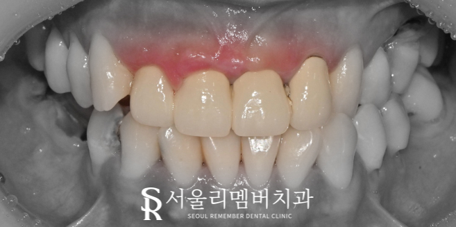 전치부 신경치료, 크라운까지 확실하게 씌워야 되는 이유는? 서울대입구역치과 관련 이미지 1