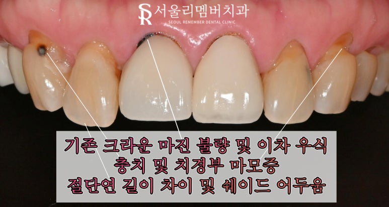 오래된 크라운 경계 불량, 이차 충치, 치경부 마모증은 앞니 라미네이트 적응증 봉천동 치과 의사 작성 관련 이미지 3