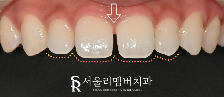 앞니 벌어짐, 레진 말고 라미네이트로 사이 틈새 자연스럽게 채우자 서울대입구 치과 상악 전치부 리얼네이트 케이스 관련 이미지 4