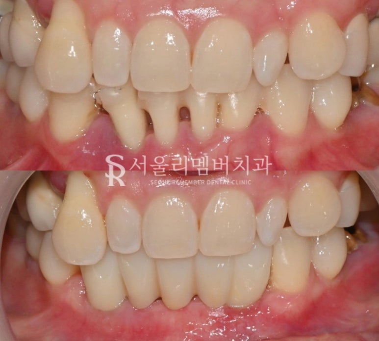 치주염으로 아래 앞니 흔들린다면? 신대방 치과 임플란트 브릿지 치료로 해결 관련 이미지 5
