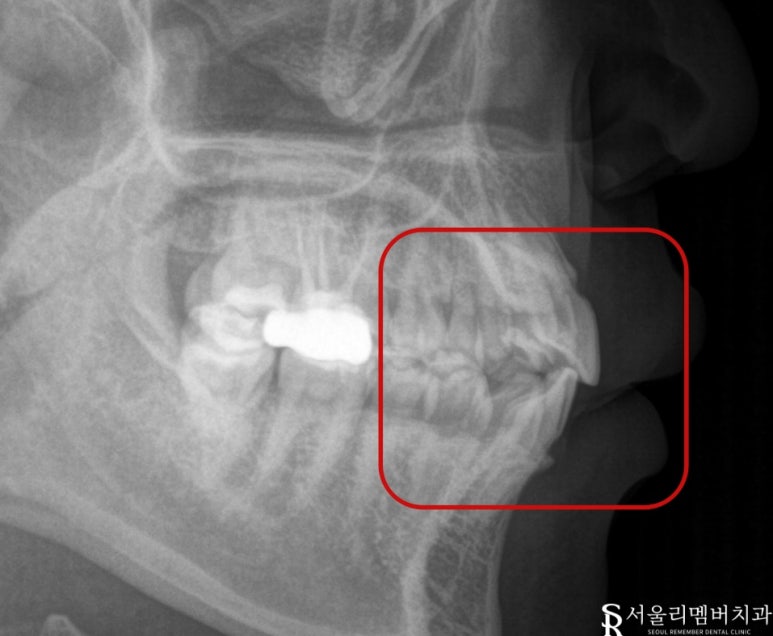 A “Pop-Out” Tooth, Cavities in the Front Teeth and Molars: Orthodontic and Cavity Treatment at a Sindae-bang Dental Clinic image 2