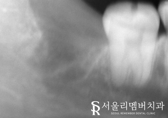 영등포 치과 대학병원 가지 않고 매복니 뽑을 수 있을까요? 관련 이미지 3