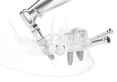 신림역 치과 염증으로 흔들리는 앞니, 심미적인 전치부 임플란트 식립 증례 관련 이미지 3