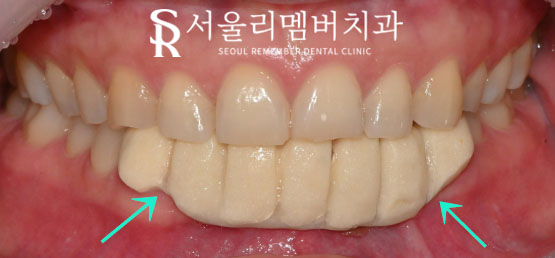 서울대입구역치과 에서 아래 앞니 5개를 임플란트 2개만으로 자연스럽게 회복 관련 이미지 4
