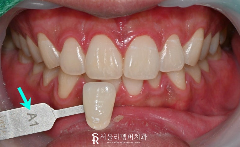 신대방 치과 치아미백 잘하는 곳 추천, 오래 유지하려면 어떻게 해야 되나요? 관련 이미지 3
