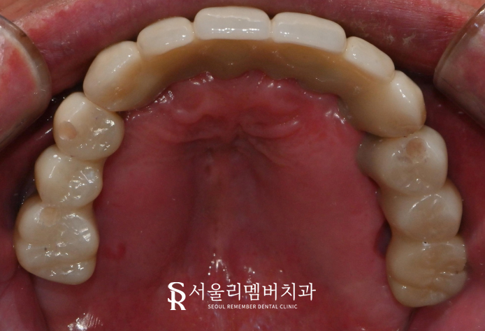 앞니 송곳니 어금니 윗니 전체 임플란트 성공 케이스 "서울대입구역 치과" 관련 이미지 4