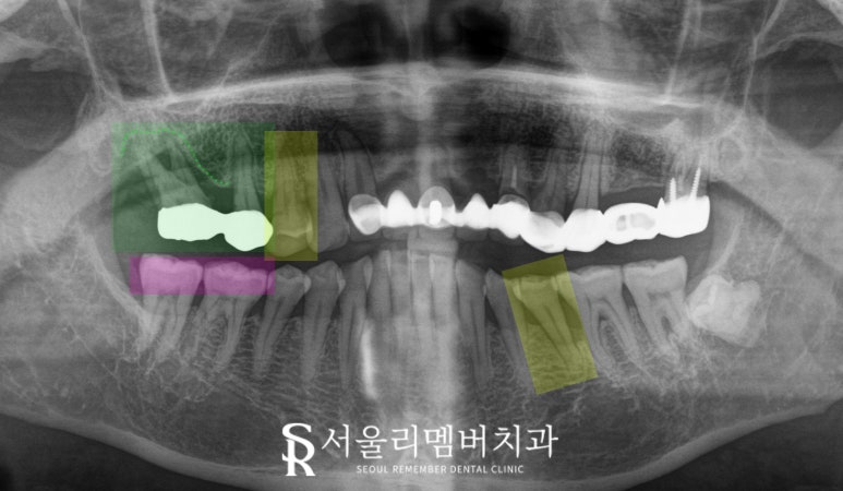 서울대입구역 치과 임플란트, 신경치료 크라운, 인레이 모두 해야 된다면 어떤 진료부터 시작해야 될까요? 관련 이미지 4