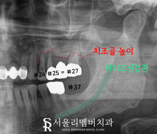 봉천동 치과 임플란트 치료 과정, 어금니가 없어서 식사가 어려워요. 관련 이미지 5