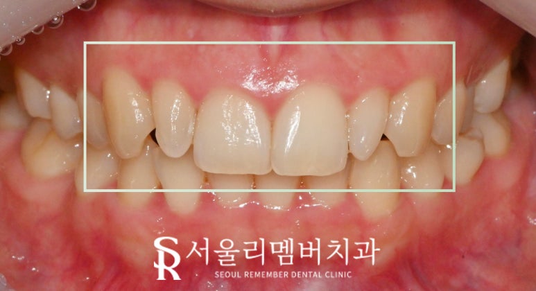 봉천동 치과 작은 앞니 왜소치 최소 삭제 및 통증 손상 없는 리얼 라미네이트 (Laminate)로 6전치 보철 수복 치료 관련 이미지 3
