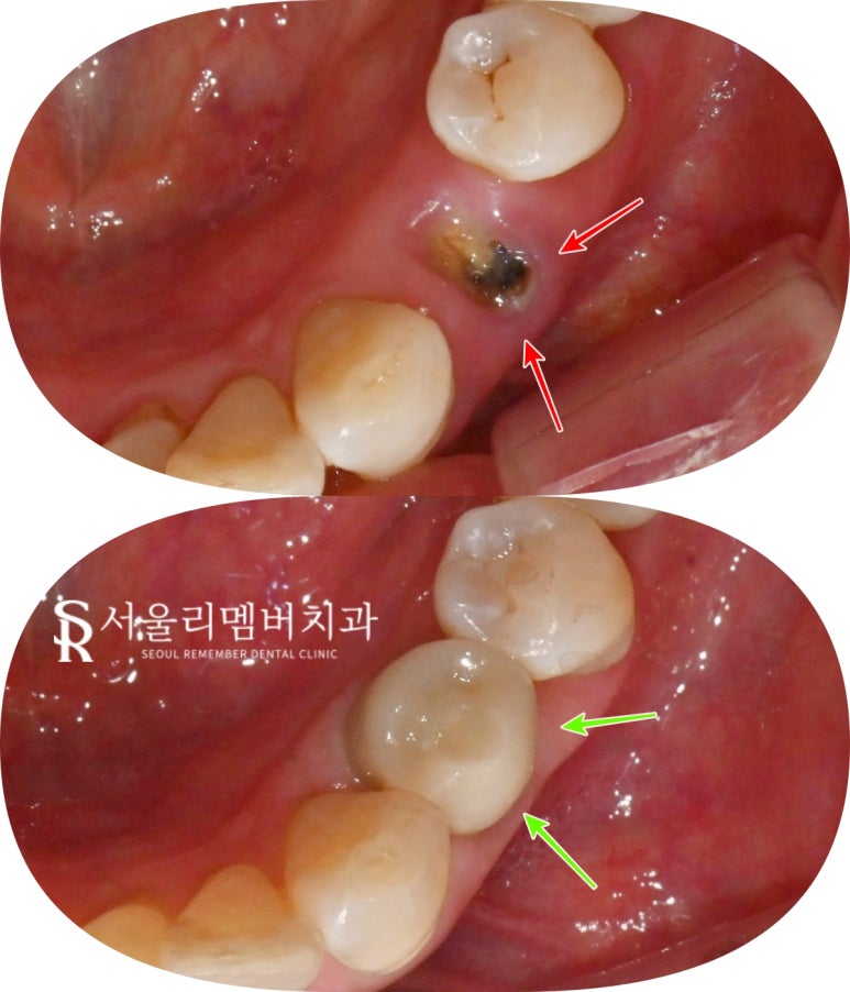 보라매 치과 신경치료 치아 부러짐, 당일 발치 즉시 임플란트 동시 식립(Simple case) 관련 이미지 5