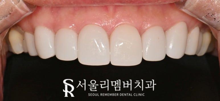 기존 라미네이트 보철 변색 및 송곳니 파절 안쪽으로 이차 우식 생겼을 때 신림역 치과 수면으로 충치치료 리얼네이트 당일 진료 가능할까 관련 이미지 6