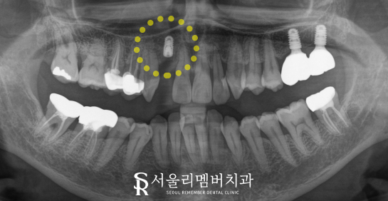 앞니 충치, 살릴 수 없는 상태라면? 서울대입구 임플란트 치과에서 해결 관련 이미지 4