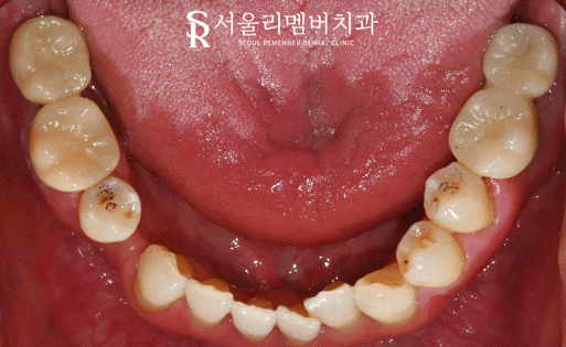 신림역 치과, 어금니 임플란트 및 보철 치료로 심미 저작 기능 개선 과정 관련 이미지 5