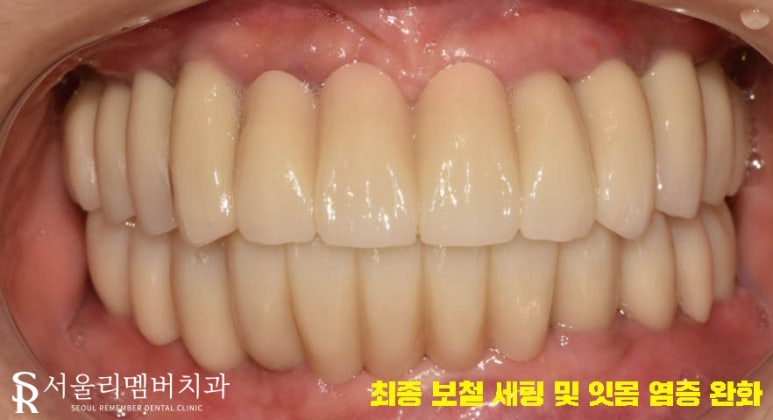 텅텅 여기저기 빠져버린 치아들, 이젠 음식을 씹을 수도 없어요.. 어떡하죠? 서울대입구역 리멤버 치과 관련 이미지 6