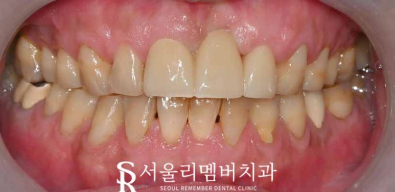 봉천동 치과 에서 신경치료 및 브릿지로 깨진 치아 회복하기 관련 이미지 4
