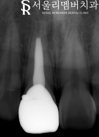 전치부 신경치료 과정과 주의사항은? (post&core) 영등포동 치과 관련 이미지 5
