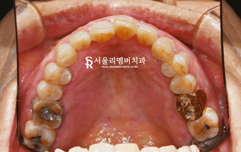봉천동 치과 상실된 치아 방치하면 안 되는 이유 (feat.임플란트 브릿지 보철치료) 관련 이미지 2