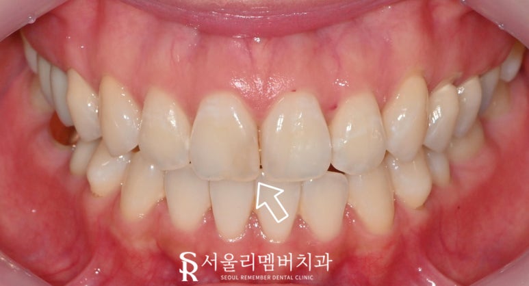 Concerned About the Color and Shape of Your Front Teeth? Seoul National University Station Dental Clinic—Maxillary Six Anterior Veneers Extending to the Canines image 3