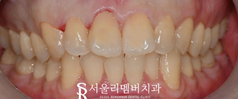 치아 부식으로 인한 마모와 충치, 낙성대 치과에서 해결 관련 이미지 2